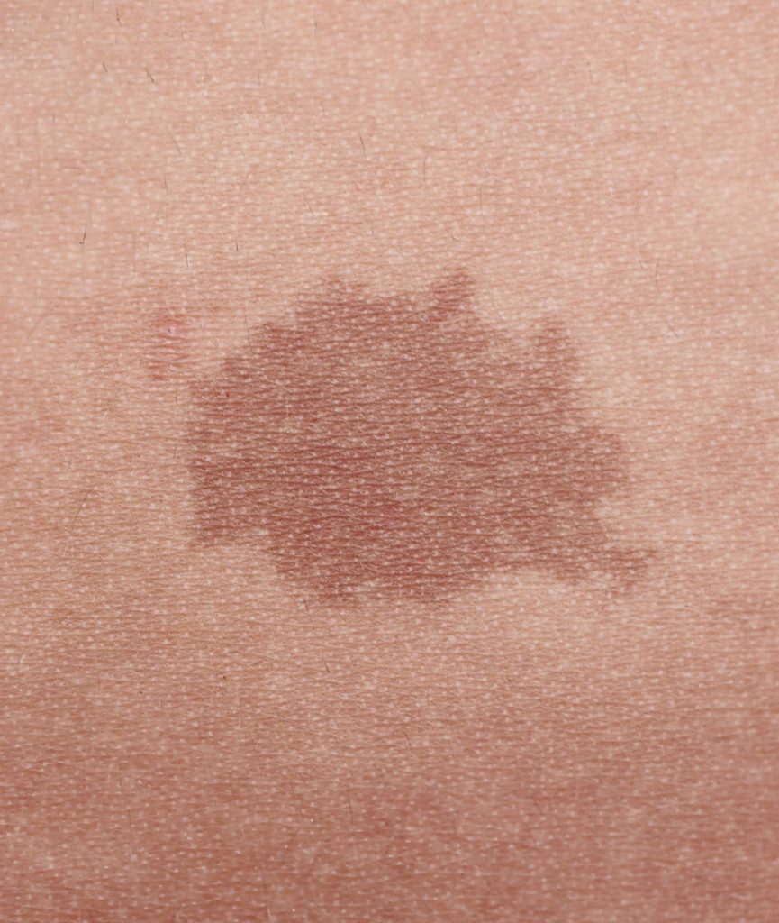 close up of a pigmented lesion on the skin
